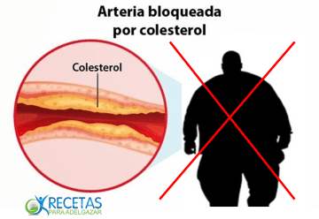 arteria colesterol  obesidad