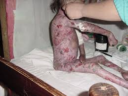 polvora, accidente, quemadura